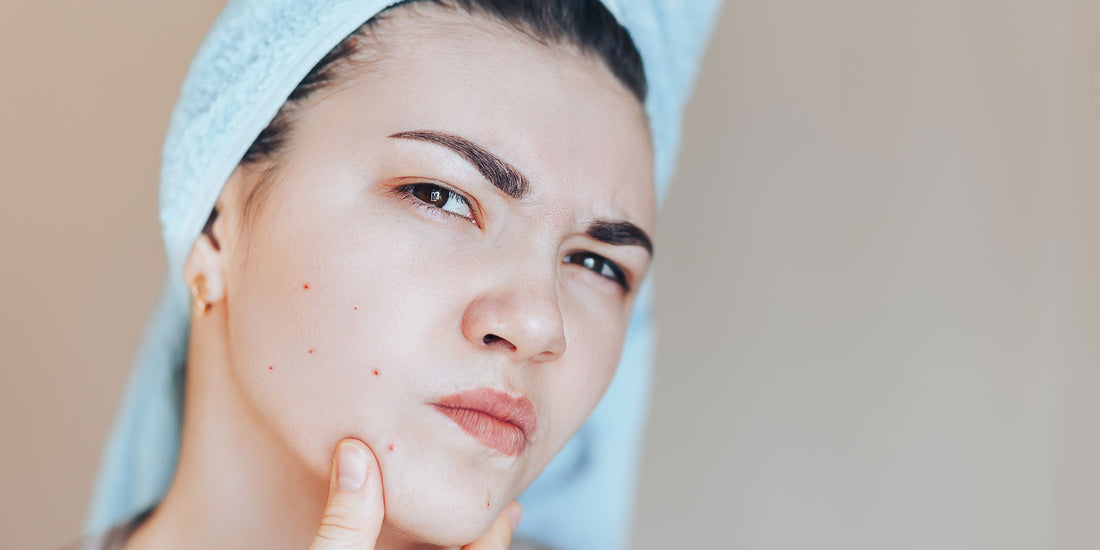 Acne Prone Skin: Your Guide to Clear Complexion