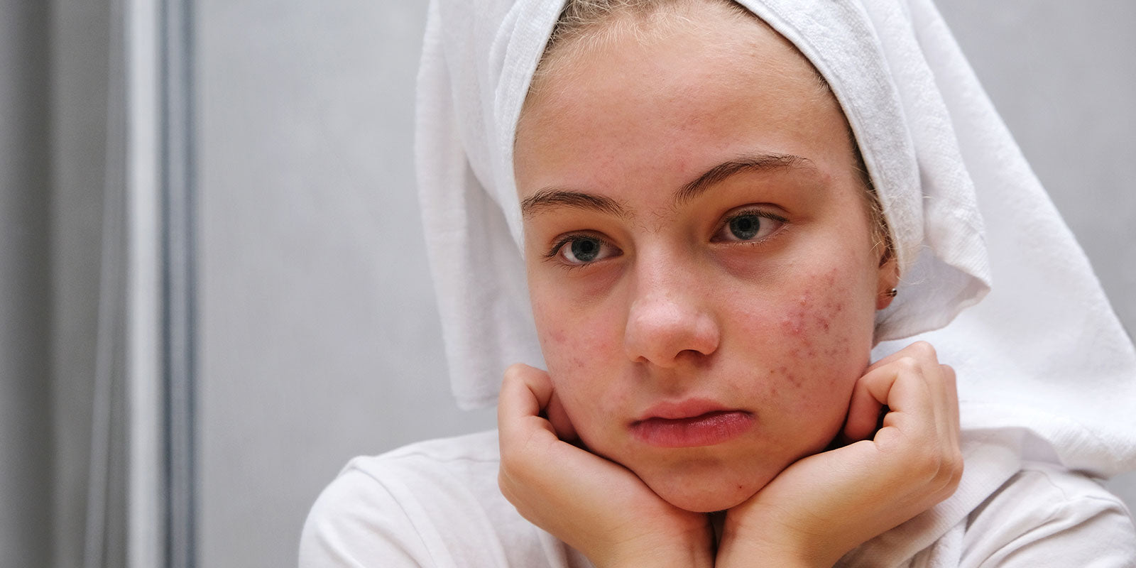 Unveiling the Acne Journey: Navigating the Path to Clear Skin – Hi-2 