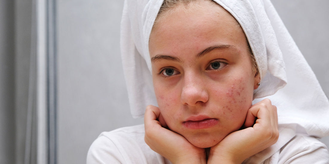 Unveiling the Acne Journey: Navigating the Path to Clear Skin